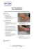 UCS™ - Ulcer Cleansing System UCSol™