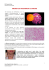 tiroidite di hashimoto e cancro
