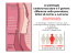 La patologia cerebrovascolare e il genere: differenze