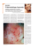 Acne: cause e sintomi - Il Dermatologo Risponde